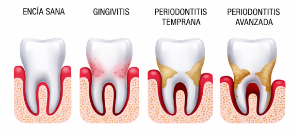 Etapas enfermedad periodontal Etapas enfermedad periodontal
