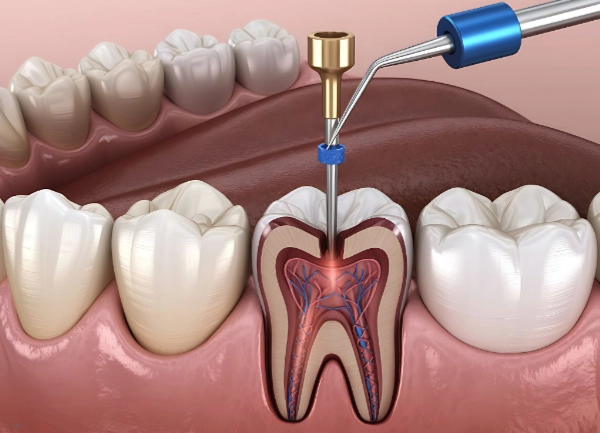 Endodoncia con infección