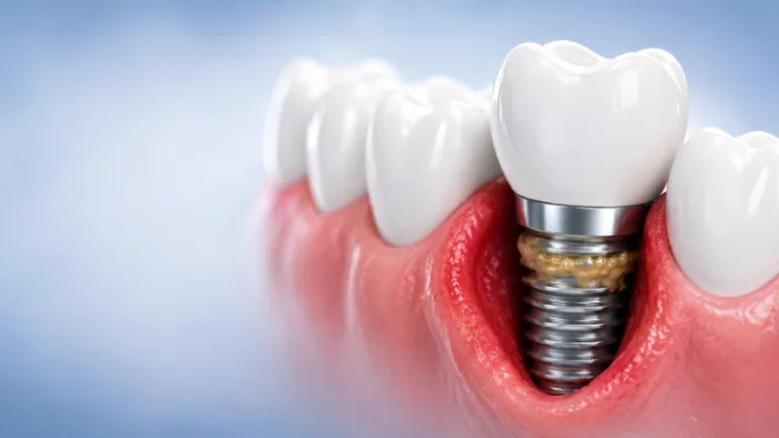 Periimplantitis: qué es, cómo prevenirla y cómo tratarla