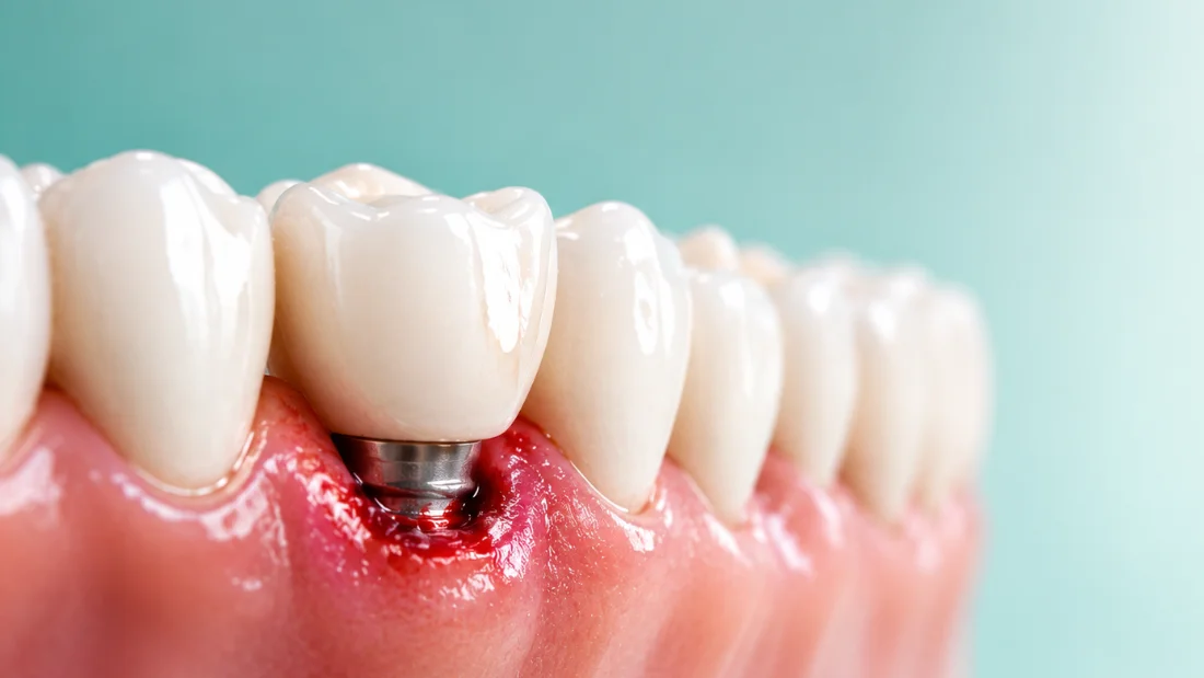 Síntomas de rechazo de un implante dental: 7 señales que no debes ignorar